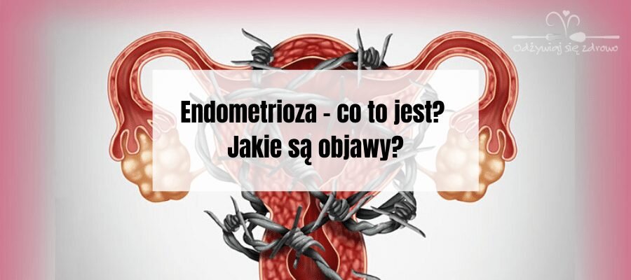 Endometrioza – co to jest? Jakie są objawy?