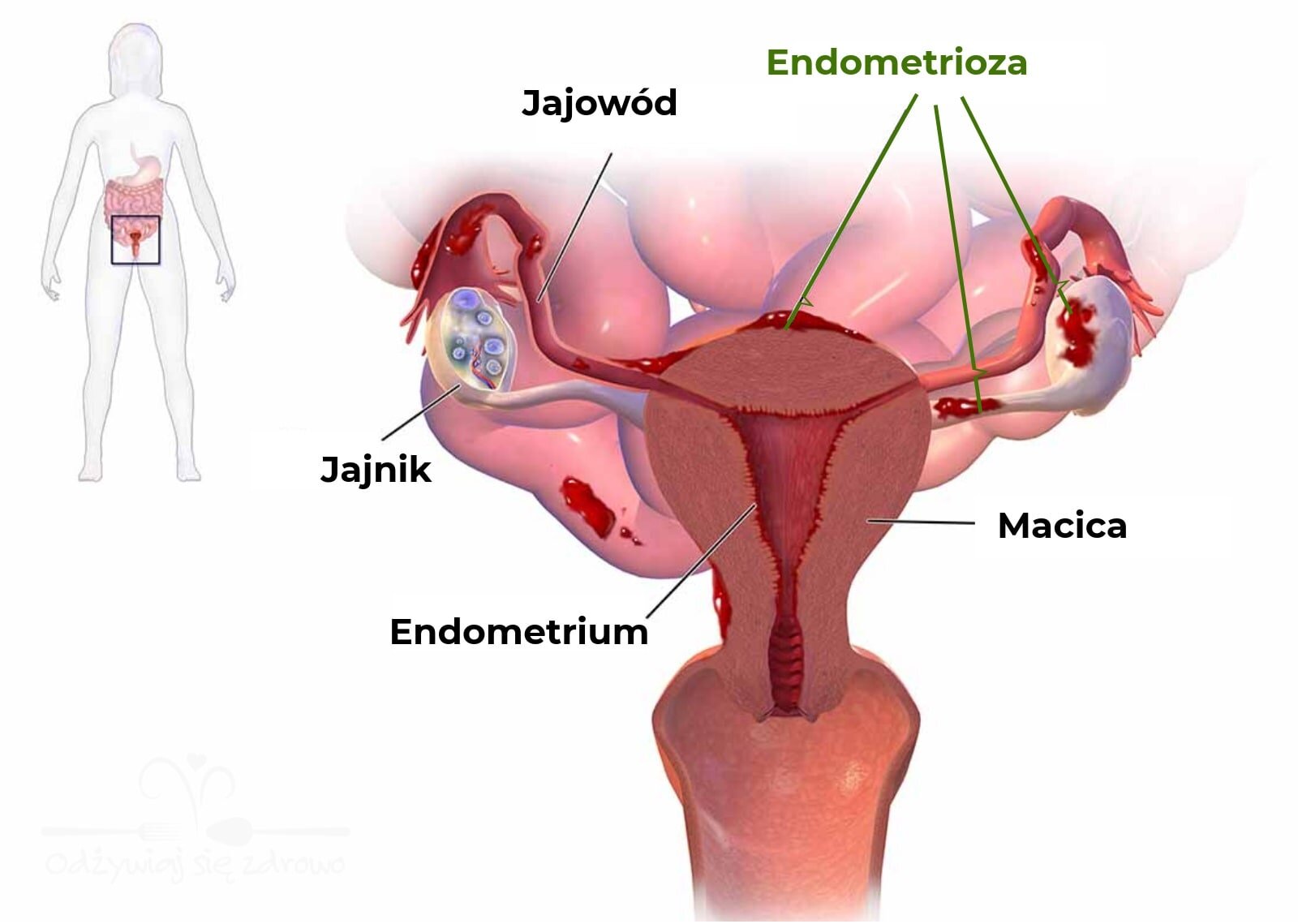 Gdzie się pojawia endometrioza - schemat